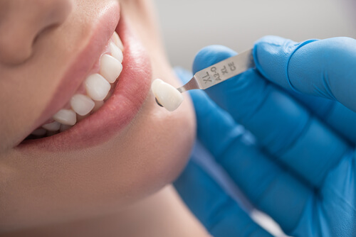 4 Important Things You Need to Know About Dental Crowns