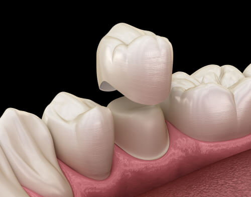 6 facts you need to know about veneer and crowns - DRHC Dubai Dental Clinic