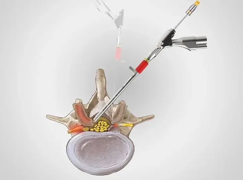 66040427806afEndoscopic Discectomy_thumbnail_3