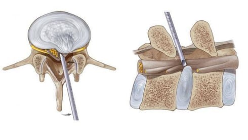 How many years does a endoscopic discectomy last?