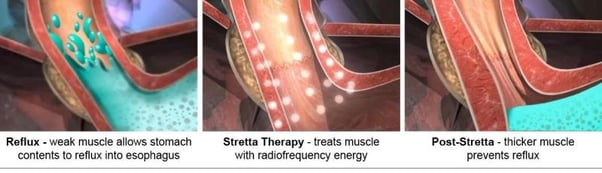 Stretta” It is an outbreak in a treatment of GERD with more than 33 clinical