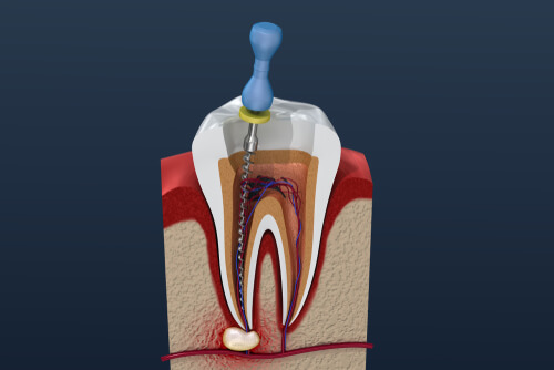 8 important things you need to know root canal treatment- Dubai Dental Clinic