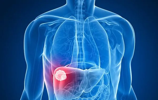 A Liver Mass Was Found on Your Scan—What Happens Next?