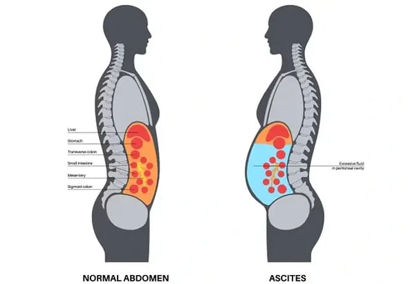 Abdominal Swelling From Ascites: When May Paracentesis Be Needed?