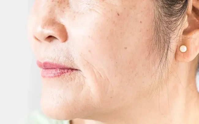 Actinic-Keratosis-Treatment-in-Dubai-drhc