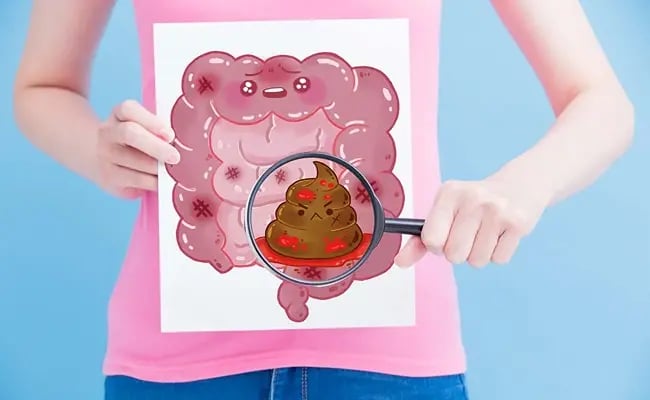 Blood in the Stool: Hemorrhoids or a Reason for Colonoscopy?