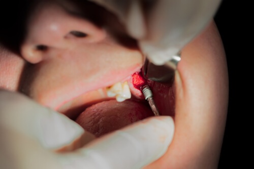 Bonegraft in Dentistry