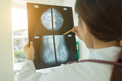 Breast Ultrasound vs Mammogram_Understanding Their Roles in Breast Cancer Screening_3