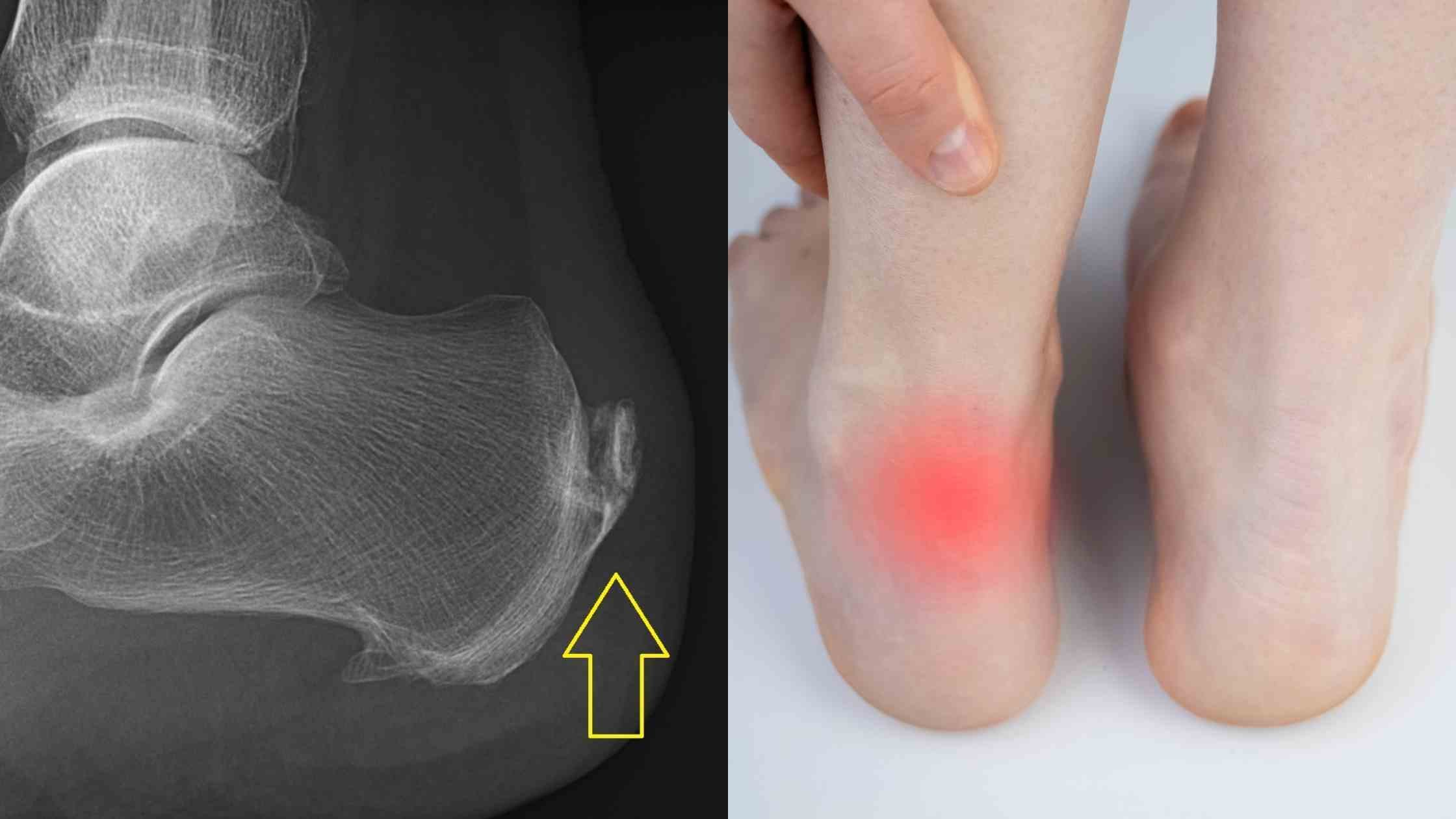 Advanced Healing Piezoelectric Shock Wave Therapy for Achilles ...