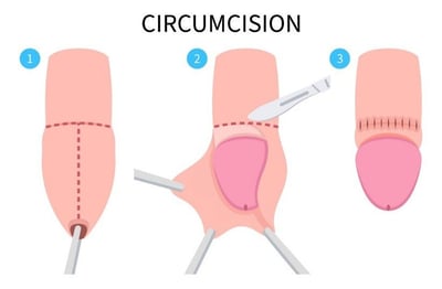 Circumcision_blog10