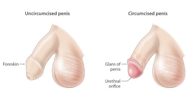 Circumcision