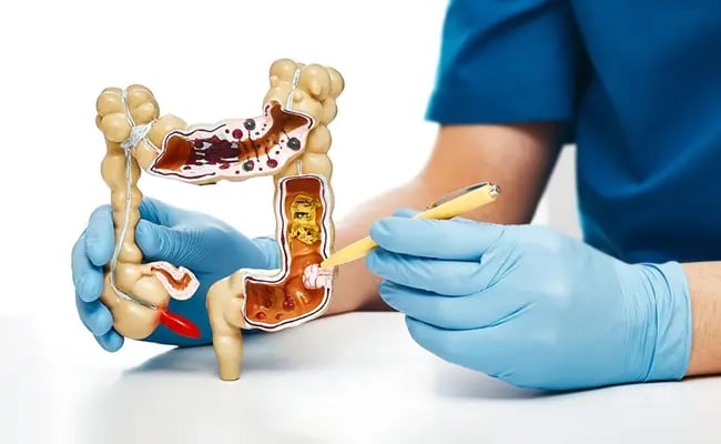 Colon Polyp Found: Can It Be Removed During the Same Colonoscopy?
