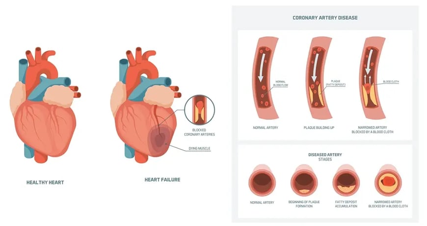 Coronary Heart Disease1