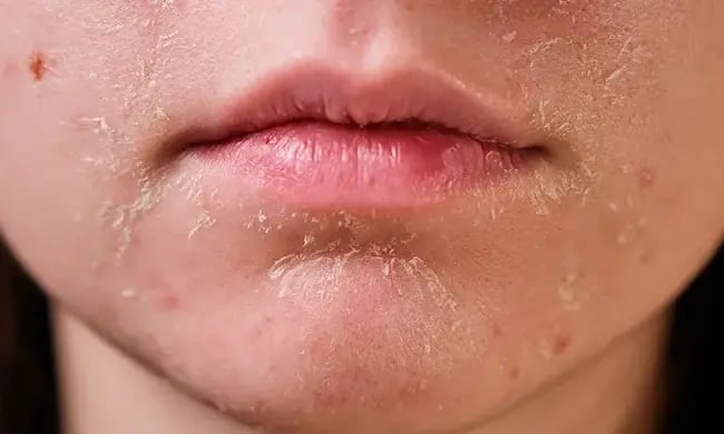 Cryotherapy for Actinic Keratosis: Preventing Sun Damage from Progressing