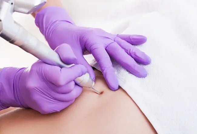 Cryotherapy for Skin Lesions: When Is Freezing Treatment the Right Choice?