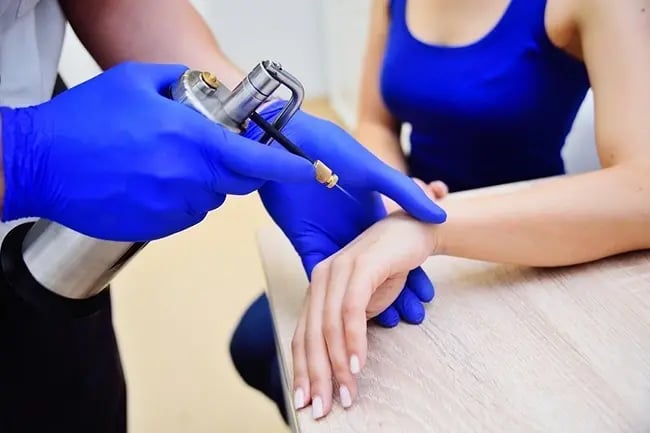 Cryotherapy for Warts in Dubai: