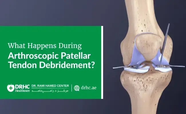 What Happens During Arthroscopic Patellar Tendon Debridement?