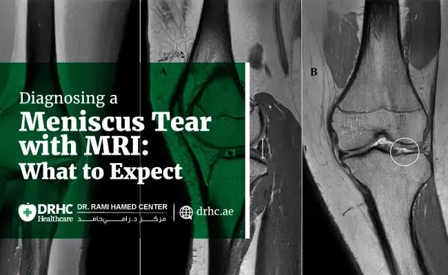 Diagnosing a Meniscus Tear with MRI: What to Expect
