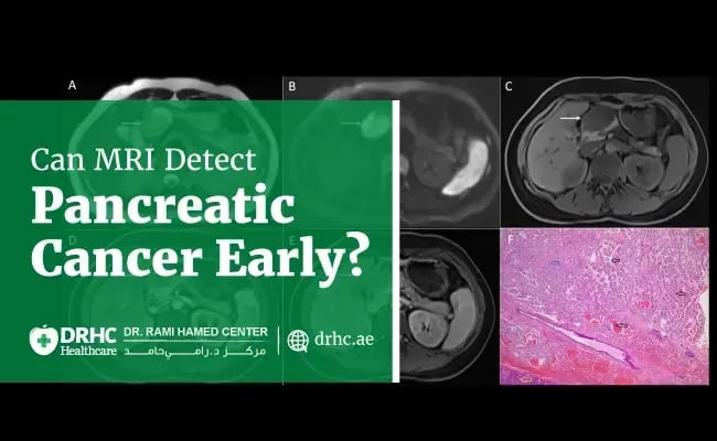 Can MRI Detect Pancreatic Cancer Early?