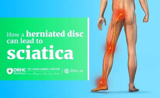 How a herniated disc can lead to sciatica