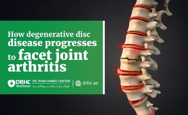 How degenerative disc disease progresses to facet joint arthritis