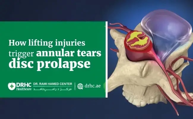 How lifting injuries trigger annular tears and disc prolapse