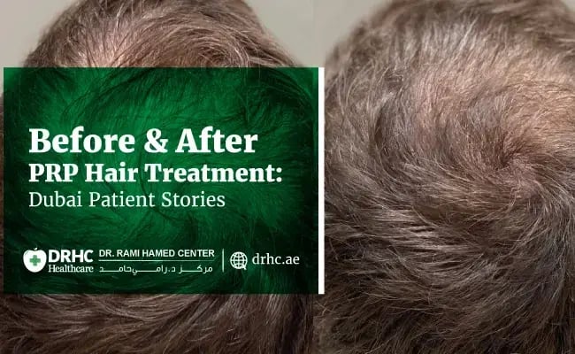 Before & After PRP Hair Treatment: Dubai Patient Stories