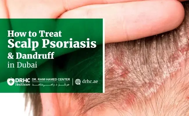 How to Treat Scalp Psoriasis & Dandruff in Dubai