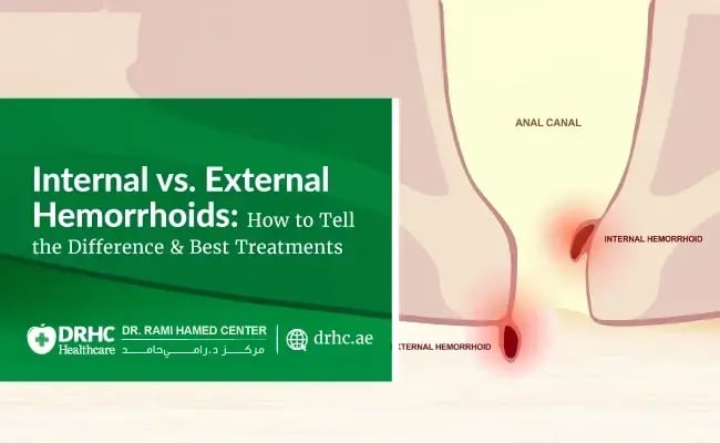 Internal vs. External Hemorrhoids: How to Tell the Difference & Best Treatments