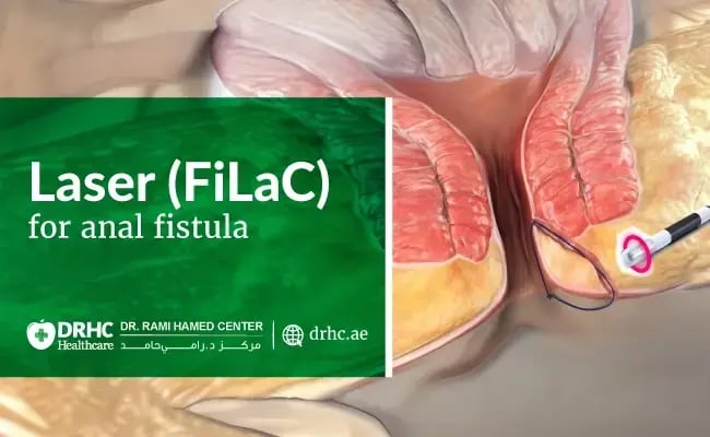 Laser (FiLaC) Surgery for Anal Fistula
