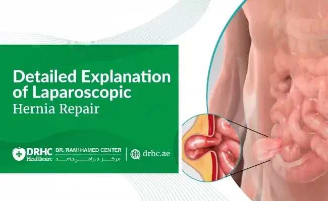 Detailed Explanation of Laparoscopic Inguinal Hernia Repair Surgery