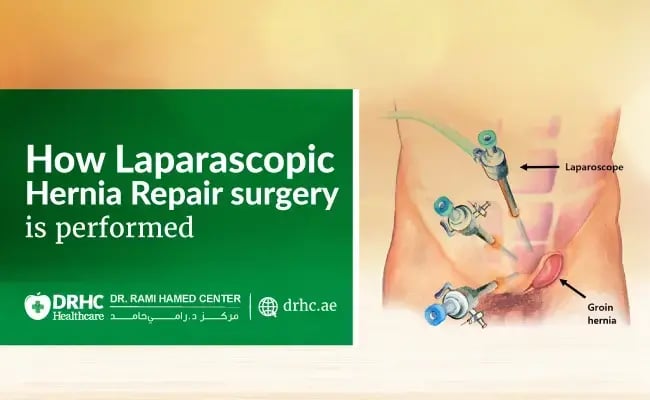 How Laparoscopic Inguinal Hernia Repair surgery is performed