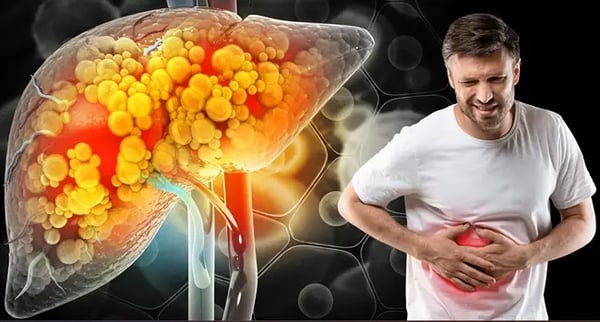 Diagnosed With Fatty Liver: When Should You See a Gastroenterologist?