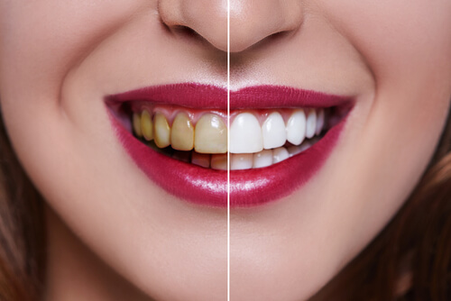 Differences in tooth preparation between a veneer & a crown