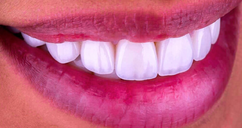 Do veneers ruin your teeth