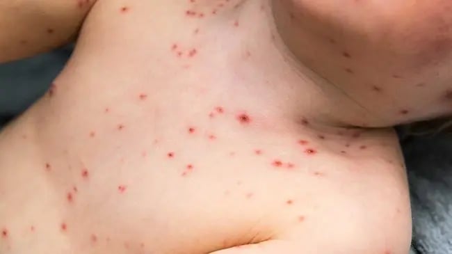 Does the Chickenpox Vaccine Mean My Child Will Never Get Chickenpox?