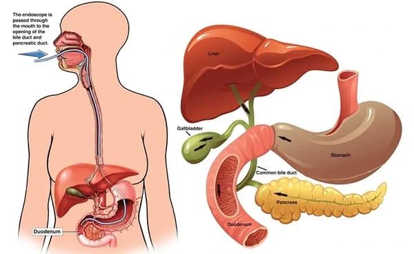 ERCP: When Is It Needed for Bile Duct or Pancreatic Problems?