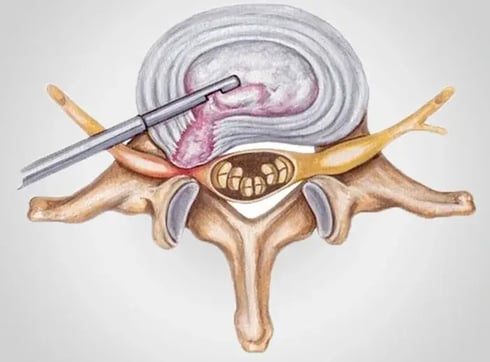 Endoscopic Discectomy_post-drhc-dubai