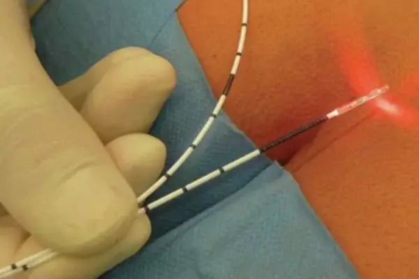 The FiLaC Procedure