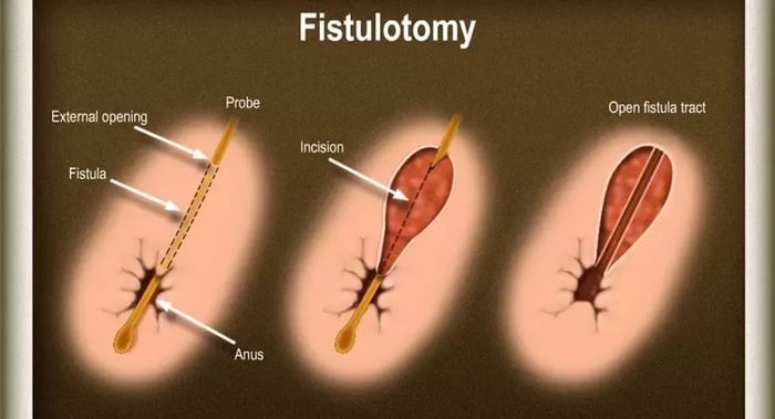 Fistulotomy