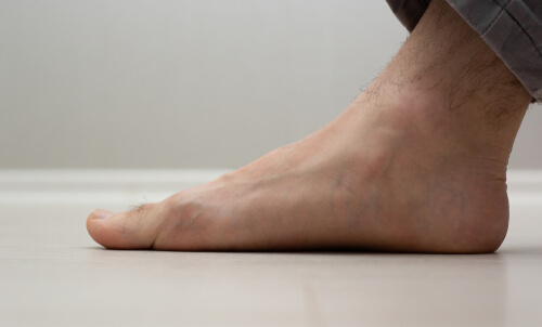 Flatfeet- Dubai Orthopedic clinic