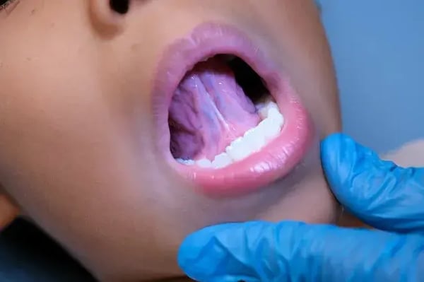 Frenectomy-with-Laser-drhc-dubai