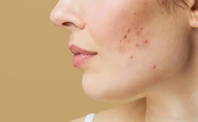 From Acne to Aesthetic Confidence: Dermatology Treatments Now Available at DRHC Healthcare Majan Clinic