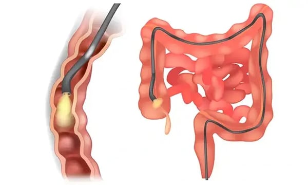 Gastroscopy With Biopsy: Why Does the Doctor Take a Tissue Sample?