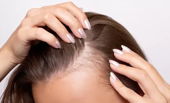 Hair Loss in Women: The Real Causes & the Latest Treatments That Actually Work in 2026