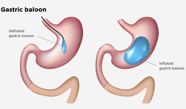 How Does a Gastric Balloon Support Weight Loss?