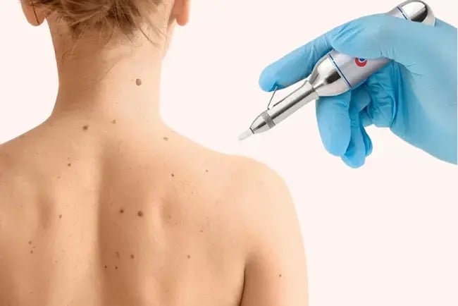 How Effective Is Skin Cryotherapy