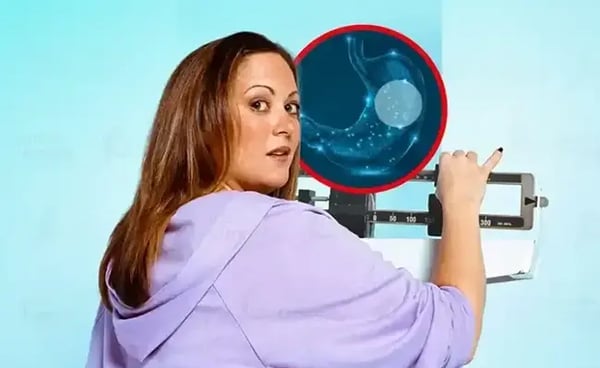 How Much Weight Could You Lose With a Gastric Balloon?