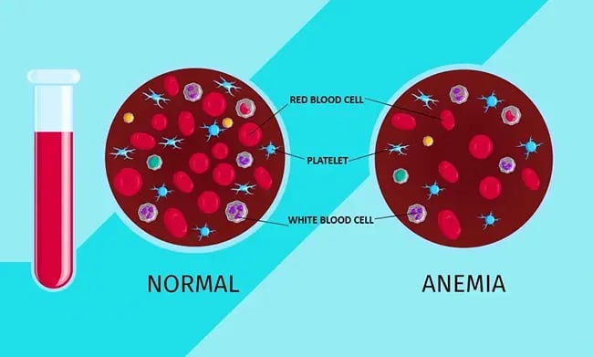 Iron-Deficiency-Anaemia-drhc-blog-post