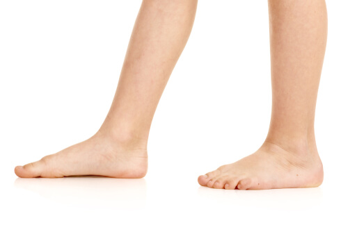 Major causes of clinic visits for pediatric foot problems
